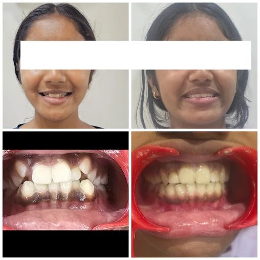 Orthodontic Alignment for Severe Crowding