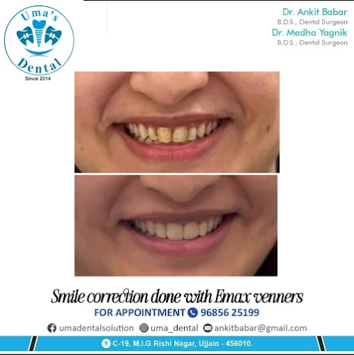 E-Max Porcelain Veneers