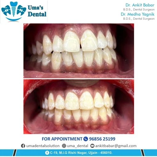 Ultrasonic Scaling & Plaque Removal