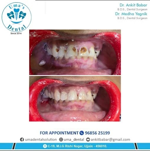 Anterior Decay Restoration & Aesthetic Fillings