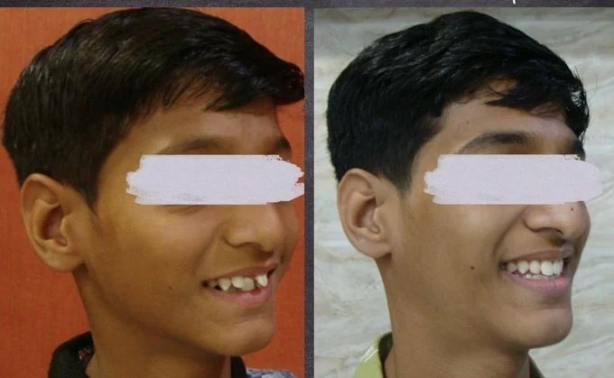 Underbite & Anterior Crossbite Correction
