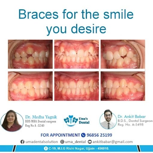 Full Arch Orthodontic Bite Rehabilitation