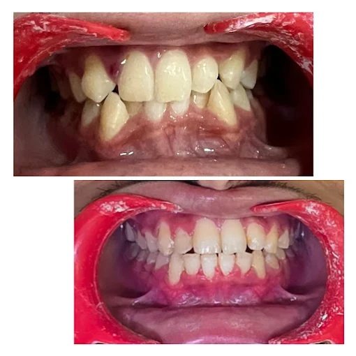 Bite Correction & Malocclusion Treatment