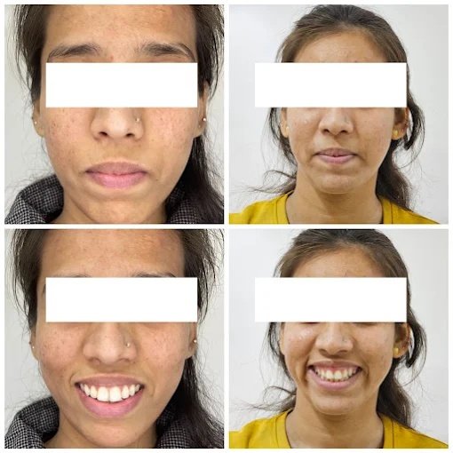 Facial Profile & Smile Symmetry Correction