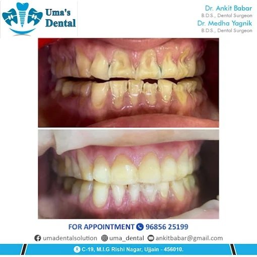 Severe Stain Removal & Teeth Whitening