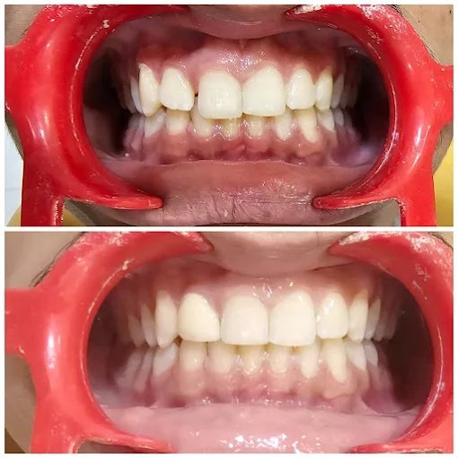 Aesthetic Gap Closure & Alignment